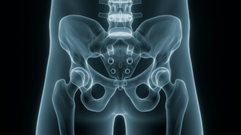 Hip Replacement Recovery: Rehab in Johannesburg