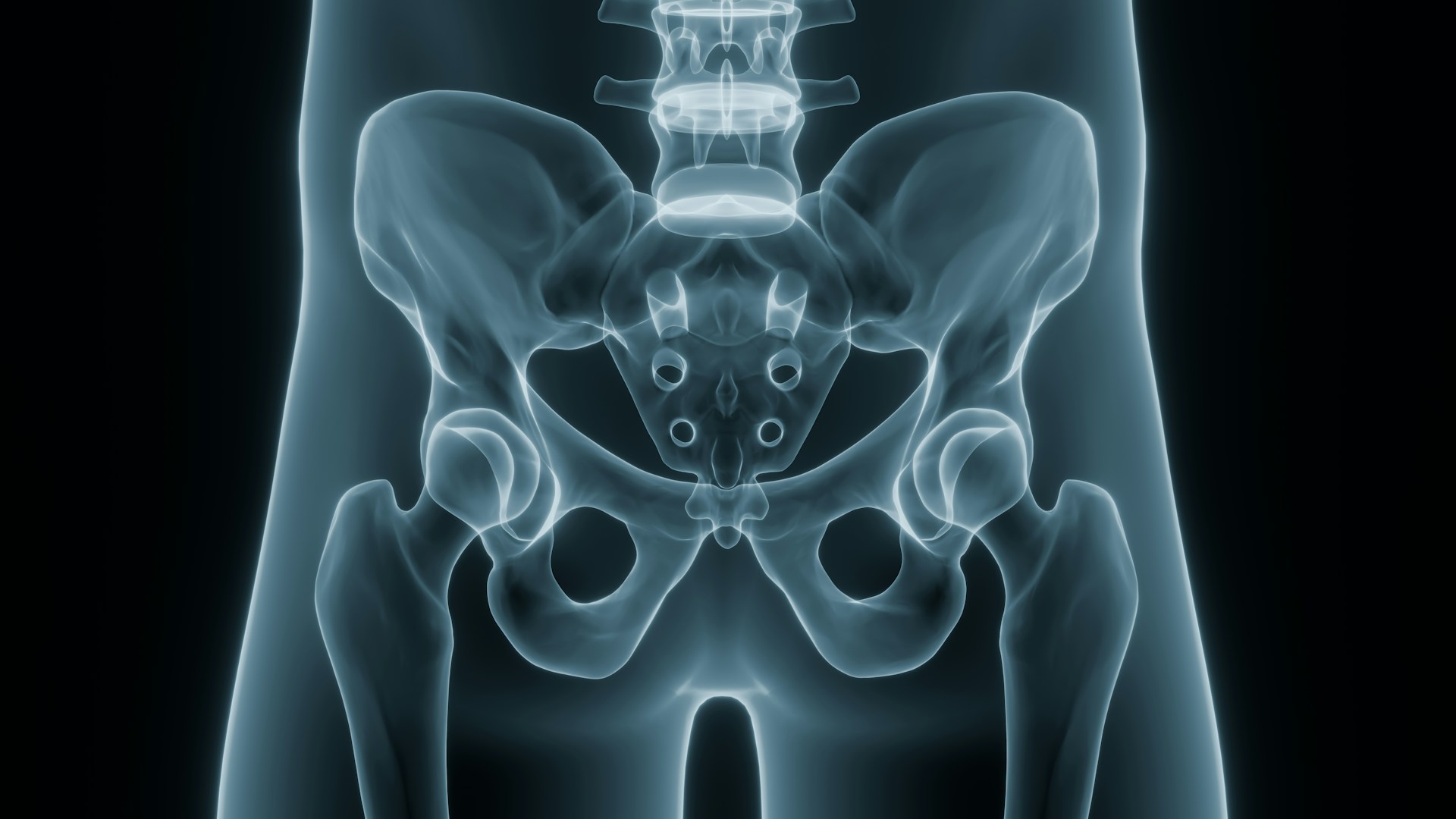 Hip Replacement Recovery: Rehab in Johannesburg